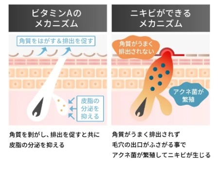 ゼオスキン-ニキビ・ニキビ跡への効果