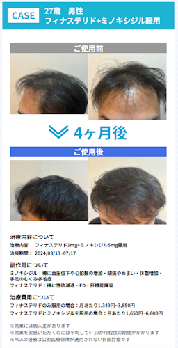レバクリ,AGA治療,症例