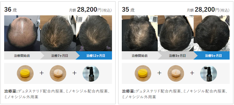 AGAヘアクリニックの症例