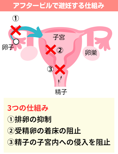 アフターピルで避妊する仕組み