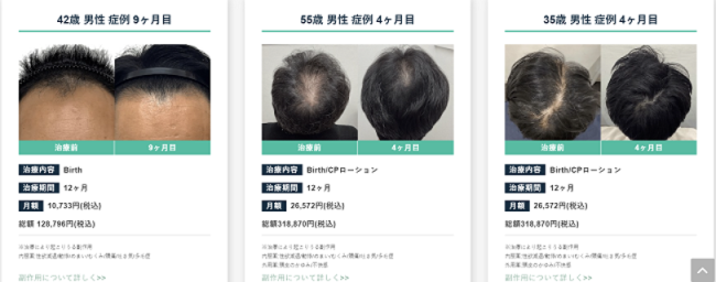 Dr.AGAクリニックのAGA治療の事例【写真付き】