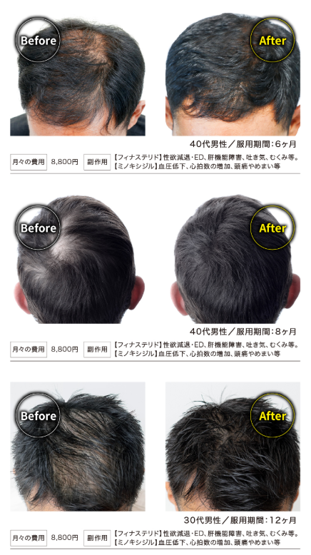 医療法人栄仁会のAGAオンライン診療,AGA治療の事例
