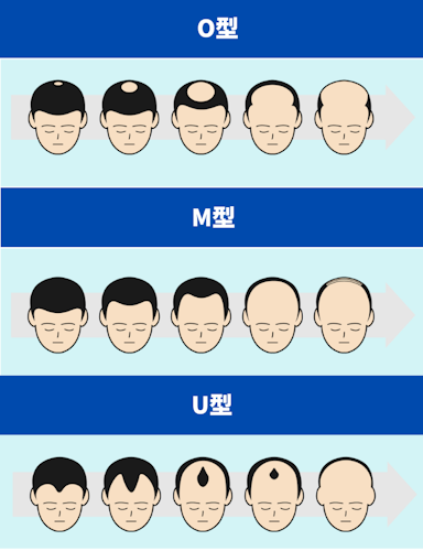 はげでもかっこいい人,進行パターン