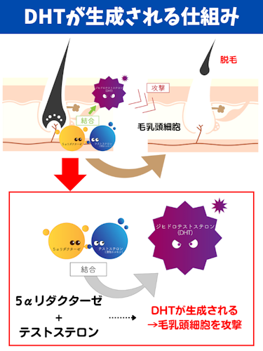 aga,発症したら終わり,DHT