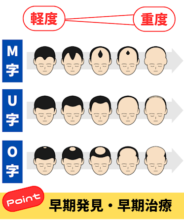 aga,発症したら終わり,セルフチェック