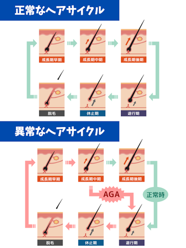 aga,発症したら終わり,ヘアサイクル