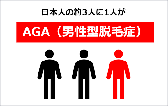 はげ,どうしようもない,AGA