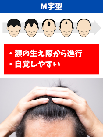 ハゲ,原因,M字型