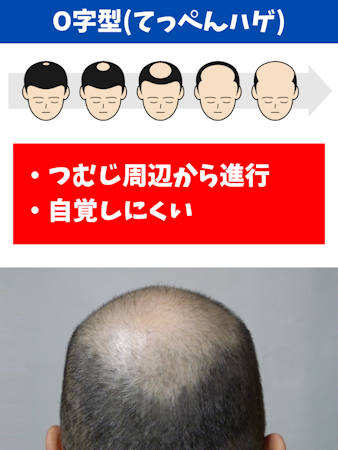 ハゲ,原因,O字型