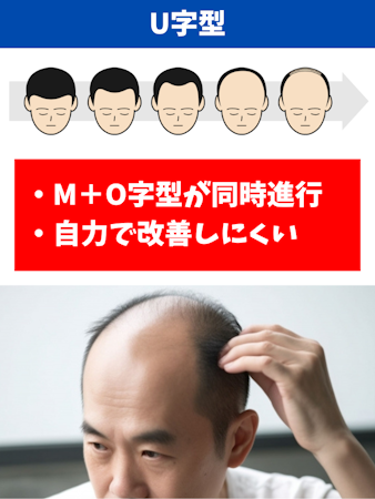 ハゲ,原因,U字型